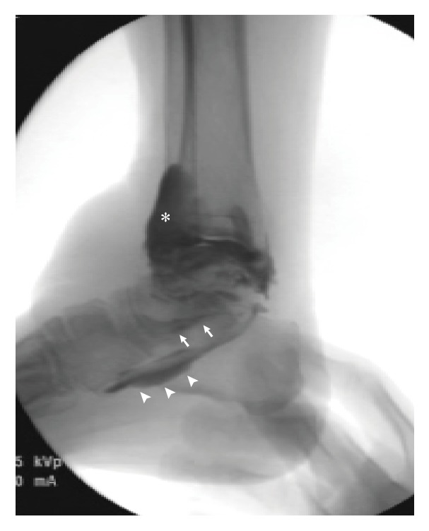 Recalcitrant Lateral Premalleolar Bursitis of the Ankle Associated with ...