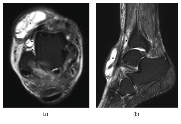 Recalcitrant Lateral Premalleolar Bursitis of the Ankle Associated with ...