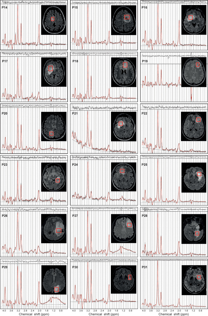 In vivo MR spectra acquired with a point-resolved spectroscopy sequence optimized for D-2-hydroxyglutarate detection (echo time, 97 msec) in 18 patients with isocitrate dehydrogenase 1–mutant noncodeleted gliomas. The volumes of interest (red boxes) are shown on axial three-dimensional fluid-attenuation inversion-recovery images. Patients (P) 14–24 were included at site 1 (Centre for Neuroimaging Research Pitié-Salpêtrière Hospital, Paris, France). Patients 25–31 were included at site 2 (Spedali Civili University Hospital, Brescia, Italy). Demographic and clinical characteristics are summarized in Table 1. ppm = parts per million.