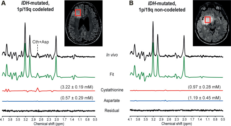 In vivo MR spectra acquired at 3.0 T with a point-resolved spectroscopy sequence optimized for D-2-hydroxyglutarate detection in two patients, (A) a 31-year-old male patient with an isocitrate dehydrogenase (IDH) 1–mutant 1p/19q codeleted glioma and (B) a 39-year-old male patient with an IDH1-mutant 1p/19q noncodeleted glioma. In vivo spectra are shown together with the LCModel fit, the cystathionine (Cth) and aspartate (Asp) contributions, and the residual. Shown in parentheses is the metabolite concentration ± Cramér-Rao lower bounds in millimolars. No line broadening was applied. The volumes of interest (red boxes) are shown on axial three-dimensional fluid-attenuation inversion-recovery images. ppm = parts per million.