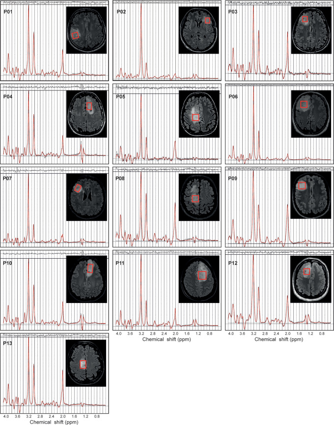 In vivo MR spectra acquired with a point-resolved spectroscopy sequence optimized for D-2-hydroxyglutarate detection (echo time, 97 msec) in 13 patients with isocitrate dehydrogenase 1–mutant 1p/19q codeleted gliomas. The volumes of interest (red boxes) are shown on axial three-dimensional fluid-attenuation inversion-recovery images. Patients (P) 1–6 were included at site 1 (Centre for Neuroimaging Research Pitié-Salpêtrière Hospital, Paris, France). Patients 7–13 were included at site 2 (Spedali Civili University Hospital, Brescia, Italy). Demographic and clinical characteristics are summarized in Table 1. ppm = parts per million.