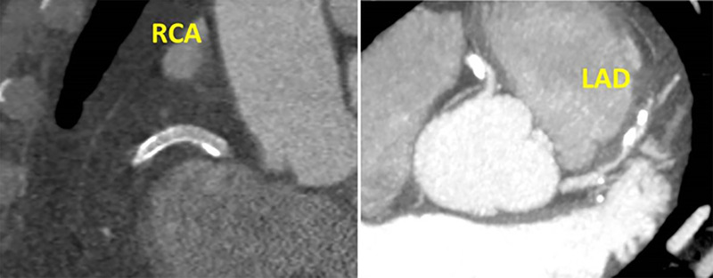 CAD-RADS 3/P3/HRP/S. Example demonstrating a patent stent (S) in the proximal RCA (0% stenosis) with high-risk plaque (HRP) in the proximal LAD with thick MIP images resulting in 50–69% stenosis and overall severe amount of total coronary plaque burden (P3). In isolation, the proximal LAD lesion would be coded CAD RADS 3/P3/HRP. However, since CAD RADS is coded on a per-patient basis, and a RCA stent is present, this patient would be coded as CAD RADS 3/P3/S/HRP.