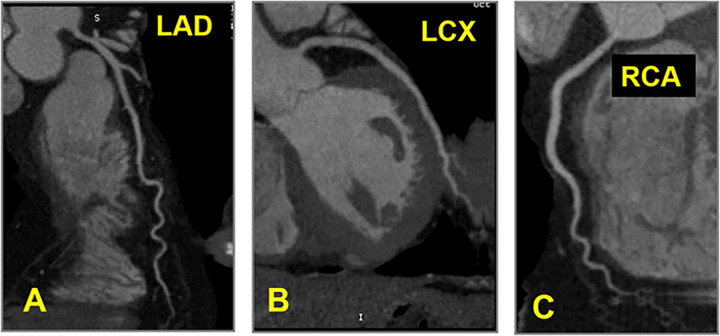 CAD-RADS 0 – No coronary stenosis. Absence of calcified and non-calcified plaque in the coronary tree. The classification P is not required for CAD-RADS 0.