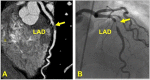 CAD-RADS 4A/P1. Focal non-calcified plaque in the mid LAD (yellow
arrow) with 70–99% severe coronary stenosis and mild amount of focal
non-calcified plaque burden (P1) (left). Invasive coronary angiography
confirming 70–99% stenosis in the mid LAD (yellow arrow, right). (For
interpretation of the references to colour in this figure legend, the reader
is referred to the Web version of this article.)