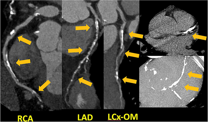 CAD-RADS 4B/P4. Plaque Burden – P4: Three vessel severe coronary stenosis with extensive amount of plaque burden – CAC = 3607.