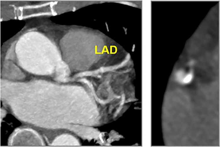 CAD-RADS N/P2. Motion artifacts obscuring the left main, LAD and LCX arteries, which renders these segments non-diagnostic (left) and moderate amount of plaque (P2 - Calcium Score = 247). Motion artifacts in the mid RCA (right) with calcified plaque.