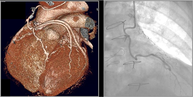 MODIFIER G. Coronary CTA demonstrating a patent left internal mammary artery to the LAD and patent saphenous vein grafts to the ramus intermedius and second obtuse marginal branch. No stenoses or luminal narrowing throughout the grafts (0% stenosis, left). Invasive coronary angiography demonstrating patent LIMA graft to the LAD (right). When evaluating coronary CTA of patients with bypass grafts, the native coronary artery segments proximal to the graft anastamoses should not be evaluated for purposes of CAD RADS coding. Only the grafts and the native coronary artery segments distal to and including the anastomosis should be evaluated for CAD RADS coding.