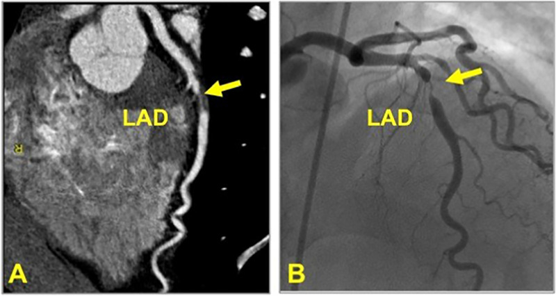 CAD-RADS 4A/P1. Focal non-calcified plaque in the mid LAD (yellow arrow) with 70–99% severe coronary stenosis and mild amount of focal non-calcified plaque burden (P1) (left). Invasive coronary angiography confirming 70–99% stenosis in the mid LAD (yellow arrow, right). (For interpretation of the references to colour in this figure legend, the reader is referred to the Web version of this article.)