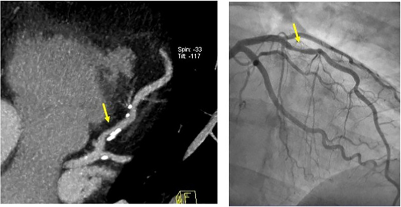 CAD-RADS 2/P2 – Mild coronary stenosis (25–49%). Plaque Burden – P2: Moderate amount of plaque burden.