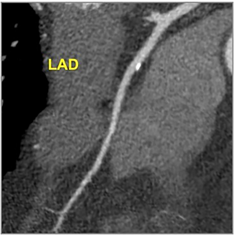 CAD-RADS 1/P1 - Minimal coronary stenosis (1–24%). Plaque Burden –P1: Mild amount of plaque burden.