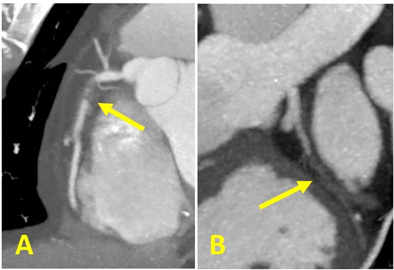 CAD-RADS 5/P3. Two examples of 5 mm thick MIPs CCTA cases coded as CAD-RADS 5. Left: Focal, non-calcified occlusion of the proximal RCA (arrow) and severe amount of plaque (P3). Right: Total occlusion of the proximal LCX (arrow) and extensive amount of plaque (P4). A small focus of “orphan” calcium along the distal LCX supports the diagnosis of chronic total occlusion.