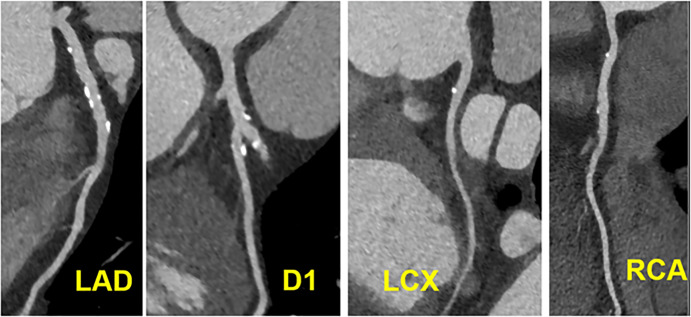 CAD RADS 1/P3 - Plaque Burden – P3: Severe amount of plaque burden – SIS = 7, Extensive amount of diffuse plaque and minimal coronary stenosis.