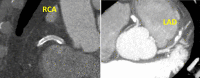 CAD-RADS 3/P3/HRP/S. Example demonstrating a patent stent (S) in the
proximal RCA (0% stenosis) with high-risk plaque (HRP) in the proximal LAD
with thick MIP images resulting in 50–69% stenosis and overall severe
amount of total coronary plaque burden (P3). In isolation, the proximal LAD
lesion would be coded CAD RADS 3/P3/HRP. However, since CAD RADS is coded on
a per-patient basis, and a RCA stent is present, this patient would be coded
as CAD RADS 3/P3/S/HRP.