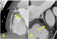 CAD-RADS 5/P3. Two examples of 5 mm thick MIPs CCTA cases coded as
CAD-RADS 5. Left: Focal, non-calcified occlusion of the proximal RCA (arrow)
and severe amount of plaque (P3). Right: Total occlusion of the proximal LCX
(arrow) and extensive amount of plaque (P4). A small focus of
“orphan” calcium along the distal LCX supports the diagnosis
of chronic total occlusion.