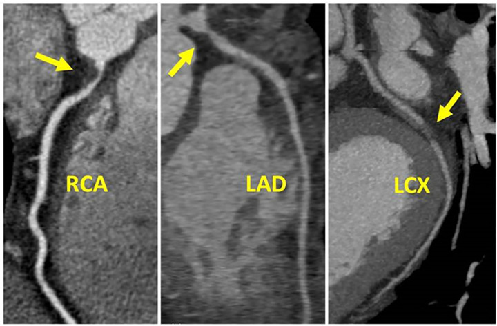 CAD-RADS 4B/P2. Three-vessel obstructive disease (>70% stenosis), including in 70–99% stenosis of the proximal RCA (left), 70–99% stenosis of the proximal LAD (middle) and 70–99% stenosis of the mid LCX (right) and moderate amount of non-calcified plaque burden (P2).