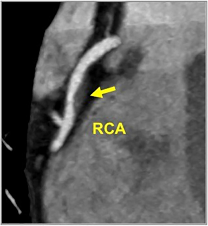 CAD-RADS 2/P2/HRP. Focal non-calcified plaque in the mid RCA with 25–49% diameter stenosis and overall moderate amount of total coronary plaque. The plaque demonstrates two high risk features, low attenuation (<30 HU) and positive remodeling, thus coding with the modifier “HRP.”