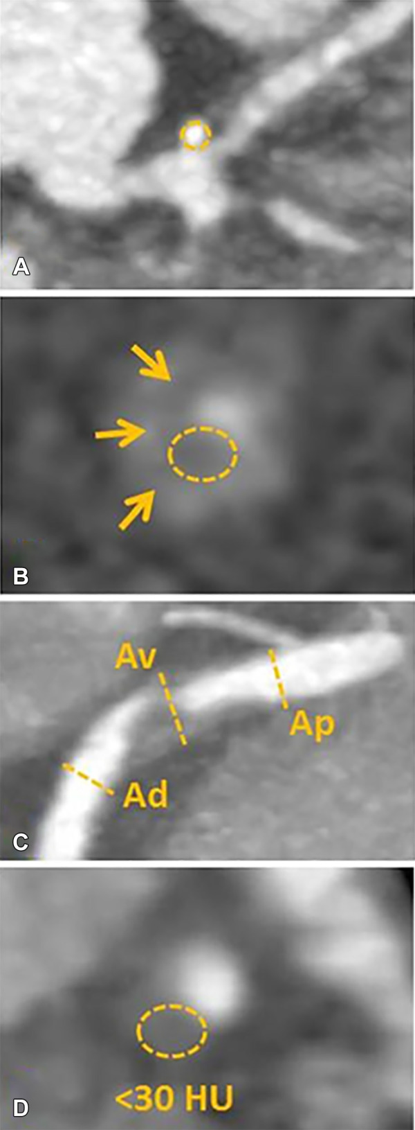 High-risk plaque (HRP) features on coronary CTA. (A) Spotty calcium, defined as punctate calcium within a plaque (B) “napkin ring sign,” defined in a non-calcified plaque cross-sectional image by the presence of two features: a central area of low attenuation plaque that is apparently in contact with the lumen; and a ring-like peripheral rim of higher CT attenuation surrounding this central area (arrows); (C) Positive remodeling, defined as the ratio of outer vessel diameter at the site of plaque divided by the average outer diameter of the proximal and distal vessel greater than 1.1, or Av/[(Ap + Ad)/2] >1.1; and (D) Low attenuation plaque, defined as non-calcified plaque with internal attenuation less than 30 HU. Please note that a combination of two or more high-risk features is necessary to designate the plaque as high-risk for CAD-RADS.