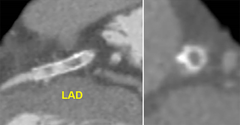 CAD-RADS 4A/P3/S. In-stent stenosis of the proximal LAD with significant luminal narrowing (70–99% stenosis) and severe amount of coronary plaque (P3). Grading of in-stent stenosis should follow the grading of normal coronary arteries (0% stenosis, 1–24% stenosis, 25–49% stenosis, 50–69% stenosis, 70–99% stenosis, and >99% stenosis). In this case, severe in-stent restenosis designates a CAD-RADS 4A lesion, which would be followed by category P3 for extensive plaque burden and the stent modifier “S” for the presence of stent.