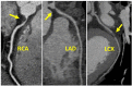 CAD-RADS 4B/P2. Three-vessel obstructive disease (>70%
stenosis), including in 70–99% stenosis of the proximal RCA (left),
70–99% stenosis of the proximal LAD (middle) and 70–99%
stenosis of the mid LCX (right) and moderate amount of non-calcified plaque
burden (P2).