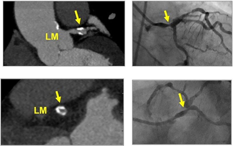 CAD-RADS 4B/P3. Distal left main stenosis with circumferential calcified plaque resulting in >50% stenosis (arrow) and severe amount of plaque (P3 - Calcium Score = 640). Upper left panel: oblique longitudinal plane of the left main coronary artery. Lower left panel – cross-sectional slice of the distal left main coronary artery. Figures on the right - Invasive coronary angiography confirming focal severe stenosis in the distal left main coronary artery.