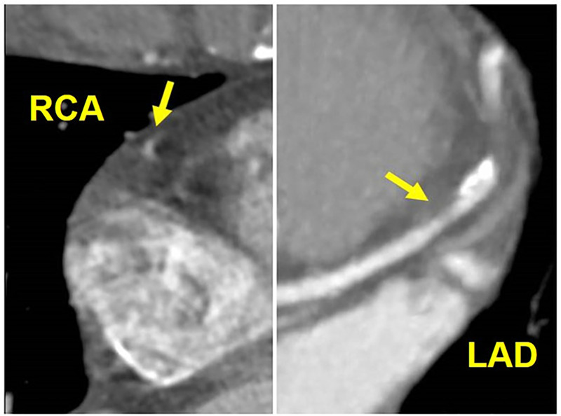 CAD-RADS 3/P2/N. Motion artifact obscuring the mid RCA (left, arrow), which renders this segment non-diagnostic. There is also stenosis of the mid LAD with 50–69% luminal narrowing (right, arrow), qualifying this lesion as CAD RADS 3 and moderate amount of coronary plaque (P2). Although the mid RCA segment is non-diagnostic, the presence of suspected obstructive disease within the LAD should be coded as CAD RADS 3/P2/N. If the LAD lesion were mild (less than 50% diameter stenosis), and no other stenosis were identified, the patient would be coded as CAD RADS N.