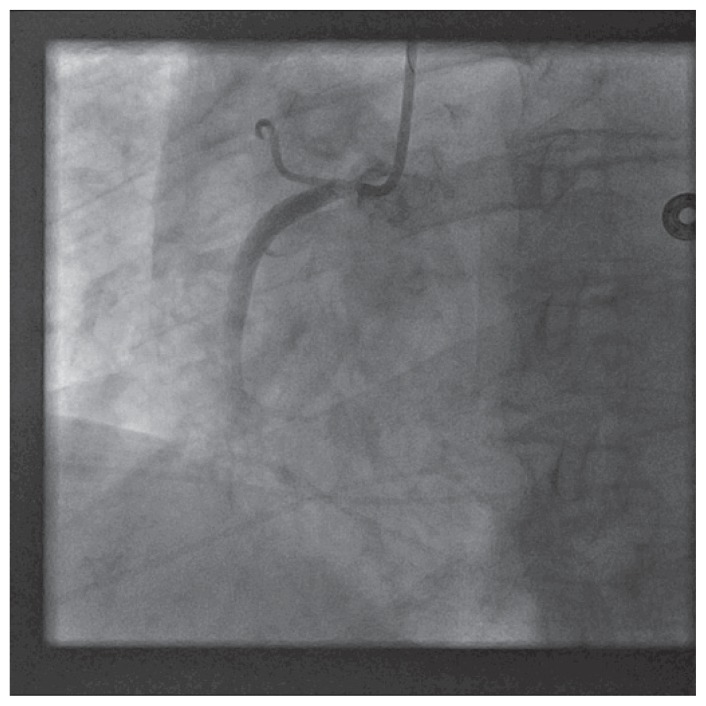 Transradial Approach Superior to Transfemoral Approach for Guide ...