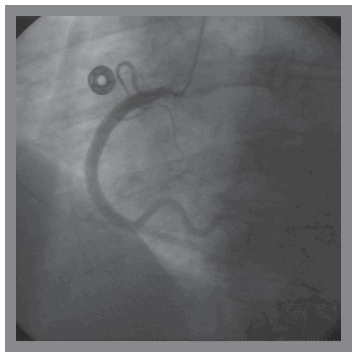 Transradial Approach Superior to Transfemoral Approach for Guide ...