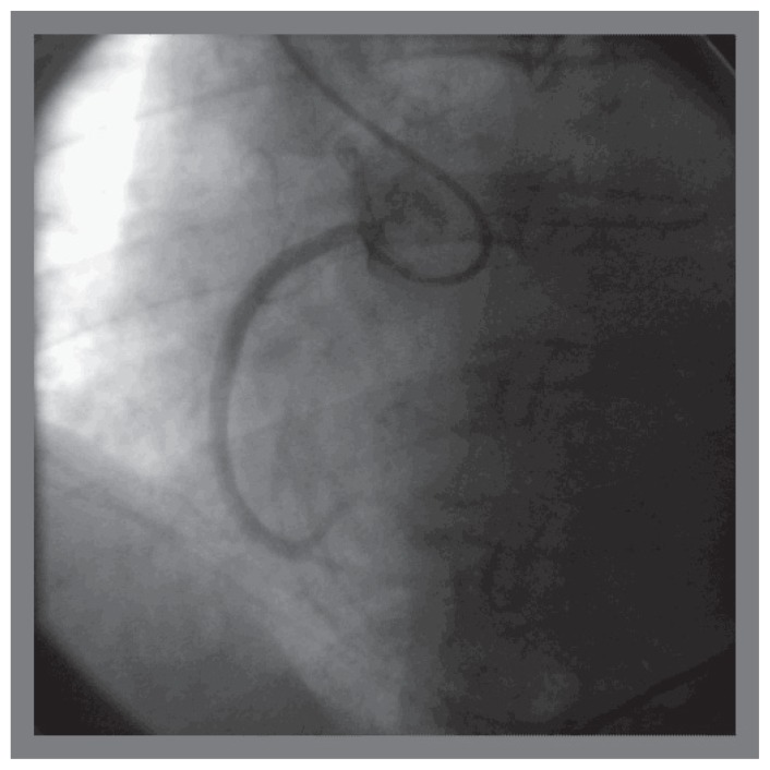 Transradial Approach Superior to Transfemoral Approach for Guide ...