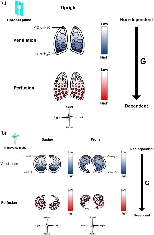 Therapeutic benefits of proning to improve pulmonary gas exchange in ...