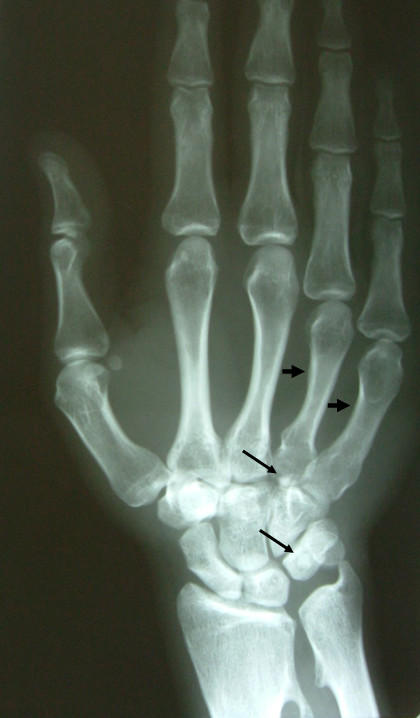 Anatomical variation of co-existence of 4th and 5th short metacarpal ...