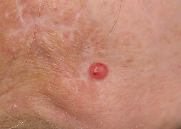 Metastatic pleomorphic dermal sarcoma: an uncommon skin tumour - PMC