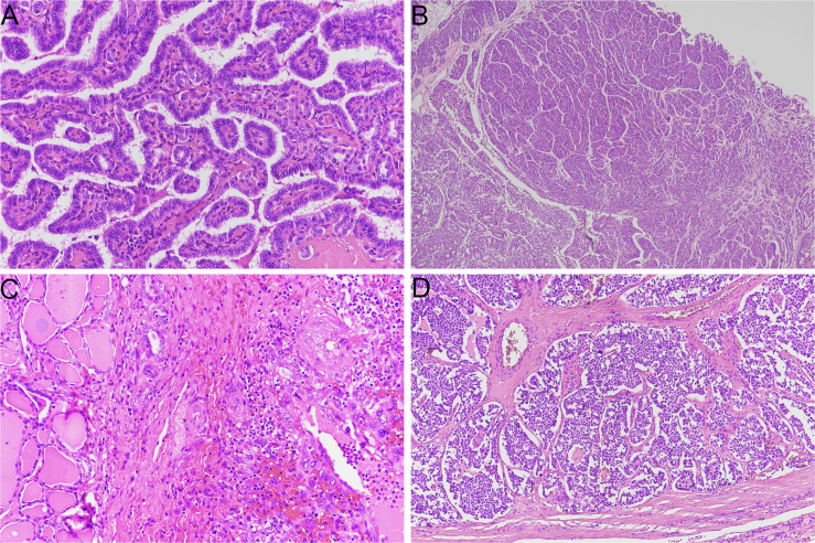 Predictive Biomarkers In Thyroid Cancer Pmc