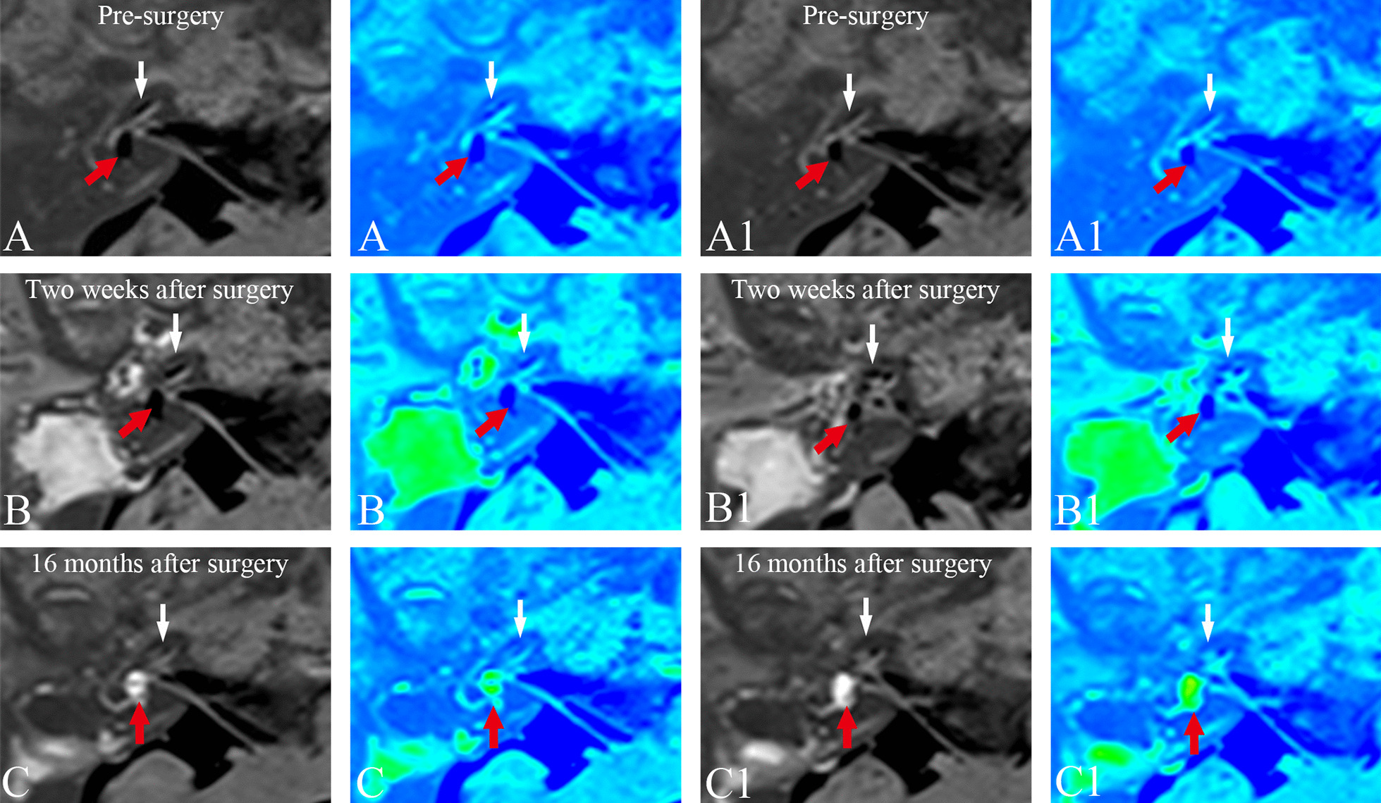 A comparison of endolymphatic duct blockage, endolymphatic sac drainage ...