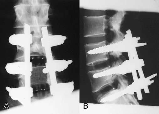 Comparison Of Two Interbody Fusion Cages For Posterior Lumbar Interbody 