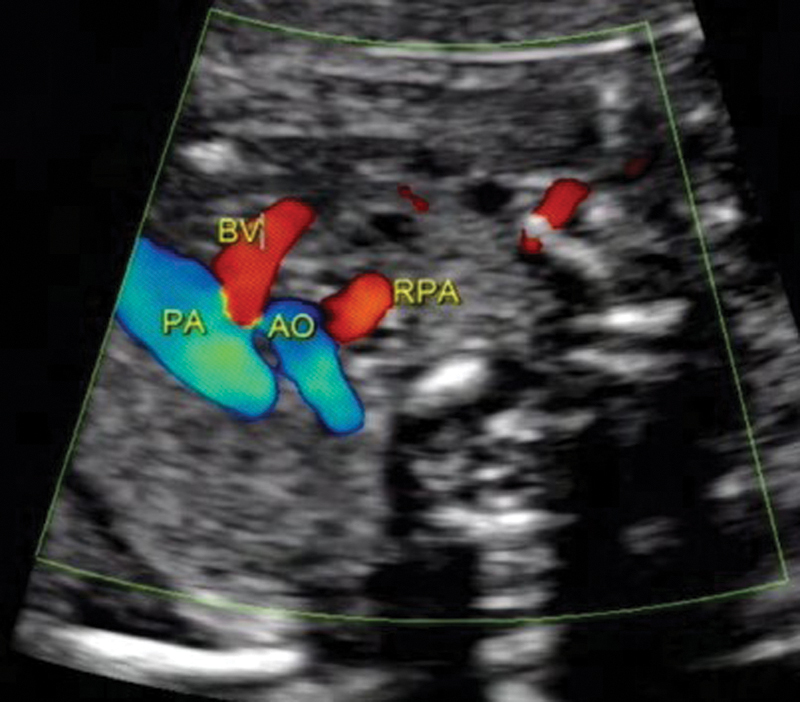 Fetal Isolated Anomalous Origin of Right Pulmonary Artery from Aorta - PMC