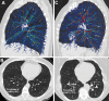 Three-dimensional CT reconstructions of the pulmonary arterial and
bronchial trees. (A, C) The pulmonary arterial tree is color-coded, with
cyan and blue indicating large and small branches, respectively, and the
bronchial tree is color-coded, with red and orange indicating large and
small branches, respectively. (A, B) Images in a 66-year-old woman with
chronic obstructive pulmonary disease (COPD) without bronchiectasis. (C, D)
Images in an 80-year-old woman with COPD with bronchiectasis (arrowheads in
D). (B, D) Images show the percentage of artificial
intelligence–based airway-to-artery diameter ratios (AARs) greater
than 1.