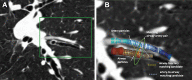 Matching process to compute artificial intelligence-based CT
measurements of the airway-to-artery diameter ratios (AARs). (A) An airway
with an accompanying pulmonary artery selected (green rectangle) to
illustrate the process. (B) Particles in the airway lumen and accompanying
artery. Dashed lines indicate airway and artery particles that match each
other (ie, matching candidate pairs). The green ellipse depicts the
airway-to-artery particle pair used to compute an AAR. The technique
calculates thousands of AARs per CT image.