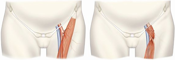 The Use Of Vascularised Muscle Flaps For Treatment Or Prevention Of