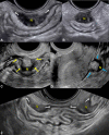 Transvaginal US shows deep endometriosis (DE) nodules (N) in the
rectosigmoid colon. (A) Image in a 31-year-old patient with dyschezia shows
an elliptical DE with tapering ends (arrows), longitudinal posterior fornix.
(B) Transverse image of nodule in A, posterior fornix. (C) Image in a
27-year-old patient with chronic pelvic pain shows an Ω-shaped DE
nodule in midrectum, longitudinal posterior fornix (arrows). (D) Image in a
33-year-old patient with deep dyspareunia shows a C-shaped nodule in
midrectum, longitudinal anterior fornix (arrows). (E) Image in a 40-year-old
patient with chronic pelvic pain shows tandem nodules of rectosigmoid colon
with tapering ends (arrows), longitudinal posterior fornix. These are
category A (ie, direct endometriosis) observations.