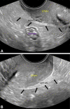 Transvaginal US in normal right and left uterosacral ligaments (USL)
in a 32-year-old patient with chronic pelvic pain and echogenic bands insert
near the posterior cervicouterine junction (arrows, A and B). Transverse
oblique images show the (A) right and (B) left anterolateral
fornices.