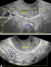 Transvaginal US images show the posterior compartment in a 25-year-old
patient with dysmenorrhea, on the retrocervical field of view (area of
interest outlined in yellow), 4–5-cm deep to the cervix. Longitudinal
(A) and transverse (B) views. The transducer is in the anterior fornix.
Longitudinal and transverse sweeps were acquired to include these
areas.