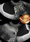 Transvaginal US images of bladder endometriosis in a 31-year-old
patient with dysuria shows a midechogenicity nodule (yellow outline)
extending from vesicouterine space into the detrusor muscle, longitudinal
(A) and transverse (B). Three-dimensional US virtual cystoscopic view is
shown (inset, arrows). This is a category A (direct endometriosis)
observation.
