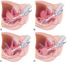 Illustration shows how to position the transvaginal sonography
transducer based on uterine position and uterosacral ligament (USL) anatomy
variations (light gray band). The relative relationship between the
transducer, USLs, and cervicouterine junction is demonstrated for (A)
anteverted uterus, anterior fornix transducer position; (B) anteverted
uterus, posterior fornix transducer position; (C) retroverted uterus,
posterior fornix transducer position; and (D) anteflexed/retroverted uterus,
anterior fornix transducer position. Reprinted, with permission, from
reference 7.