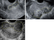 (A–C) Transvaginal US images in three reproductive-age
individuals (a 34-year-old, 41-year-old, and 37-year-old patient), all
presenting with chronic pelvic pain, demonstrate deep endometriosis of the
outer uterine serosa (yellow outline) in retroflexed uteri, which is a
category A (direct endometriosis) observation. Images were obtained with the
(A) transducer in the posterior fornix in longitudinal view, (B) transducer
in the anterior fornix in longitudinal view, and (C) transducer in the
posterior fornix in transverse view.