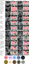 Transvaginal US posterior compartment deep endometriosis (DE) image
gallery of reproductive age individuals (19–48 years) with chronic
pelvic pain, deep dyspareunia, dyschezia, dysmenorrhea, or infertility
demonstrates the spectrum of common DE observations with schematics and
color legend. US images in columns A (Ultrasound Image A) and B (Ultrasound
Image B) are examples of similar observations in multiple patients.
Anteversion and retroversion refer to uterine position. AF = anterior fornix
transducer position, CDS = cul-de-sac, PF = posterior fornix transducer
position, Long = longitudinal view, rans = Transverse view,.USL =
uterosacral ligament.