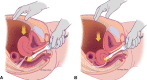 Illustration shows the uterine sliding maneuver, posterior fornix
transducer position, anteverted uterus (A) and retroflexed uterus (B).
Adapted, with permission, from reference 7.