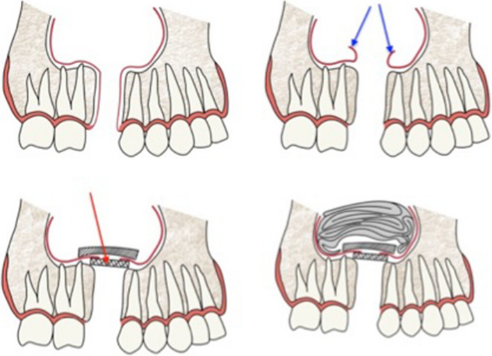 Oro-Antral Fistulas and their Management: Our Experience - PMC