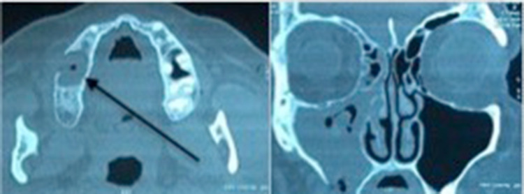 Oro-Antral Fistulas and their Management: Our Experience - PMC