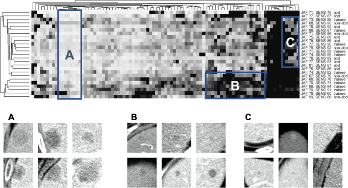 Clustering of metastasis features and reader confidence. Top: Clustergram of the reader confidence matrix. Columns correspond to metastases (n = 91), rows correspond to readers (n = 25), and brightness corresponds to reader confidence. Columns and rows are permuted to bring clusters together, with phylogenetic trees on the top and left to show empirically discovered relationships between similar metastases or readers. Reader data are shown on the right (abd = abdominal subspecialist, non-abd = nonabdominal subspecialist), including the jackknife alternative free-response receiver operator characteristic curve score (JAF) and sensitivity (SENS). Boxes A, B, and C show three areas of interest. Box A encompasses a group of metastases that were found by nearly all readers (ie, easy, nondiscriminatory). Box B encompasses a group of metastases that were scored with lower confidence for five trainees and one nonabdominal subspecialist. Box C encompasses a group of metastases that were challenging to detect: approximately half of the readers were able to detect these lesions, with no clear connection between reader experience and detection rate. Bottom: Close-up images of six metastases randomly selected from each of the corresponding boxes in the top panel.