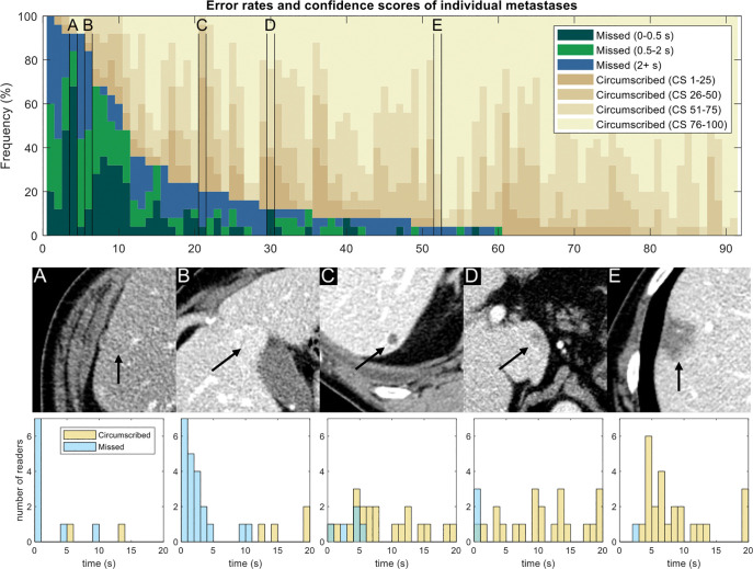 Detection rates and confidence scores for each metastasis. Each column represents a different metastasis (n = 91). Dark colors indicate missed metastases (false-negative findings), and different shades correspond to the eye gaze time. Tan shades indicate confidence for circumscribed metastases (1 = low confidence, 100 = high confidence). Metastases are sorted according to the number of false-negative errors. (A–E) Five selected metastases are marked in the plot and are shown for illustrative purposes; arrows indicate metastasis. Eye gaze histograms are shown below the images. An eye gaze longer than 20 seconds was placed into the 20-second bin. (A) Metastasis was frequently missed (23 of 25 readers) and was associated with short gaze times, implying visual search errors. (B) Metastasis also was frequently missed (21 of 25 readers) and was associated with longer gaze times, implying classification errors. (C) Metastasis was missed by only five readers, usually with long gaze times or when circumscribed readers indicated low confidence. (D) Metastasis was missed by three readers, all with short gaze times. (E) Metastasis was circumscribed by all but one reader. CS = confidence score.